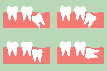 親知らずを抜いた方がよい理由