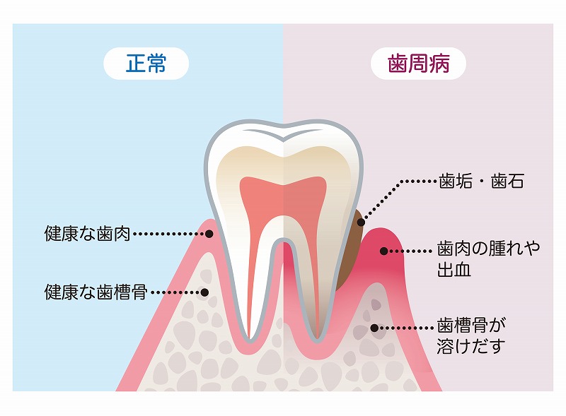 歯周病は進行度