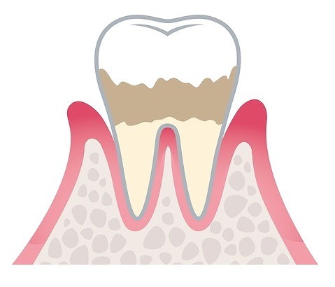 ステージ2：歯周炎（軽度）