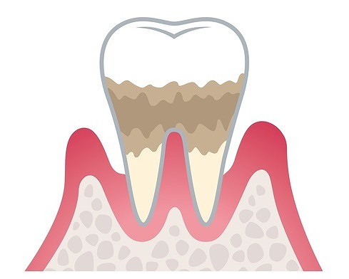 ステージ3：歯周炎（中等度）