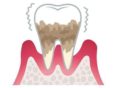 ステージ4：歯周炎（重度）
